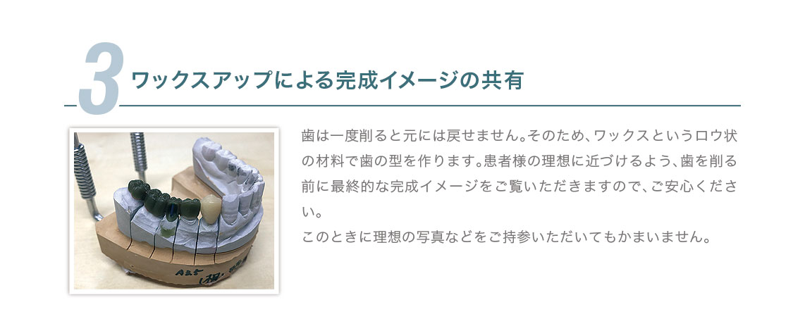 3.ワックスアップによる完成イメージの共有