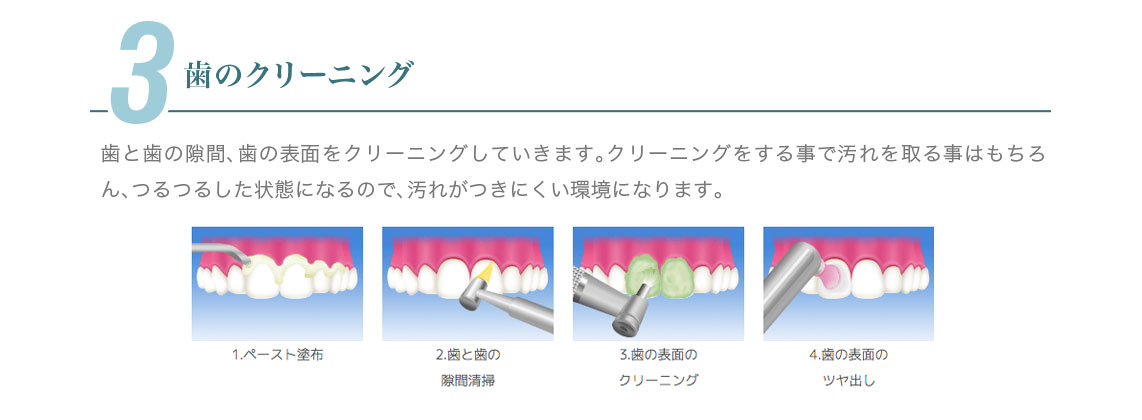 3.歯のクリーニング