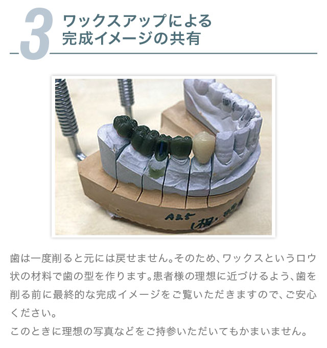 3.ワックスアップによる完成イメージの共有