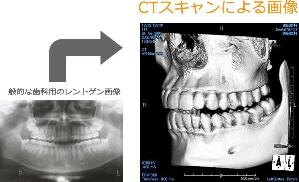 ２次元レントゲンとCTの比較画像