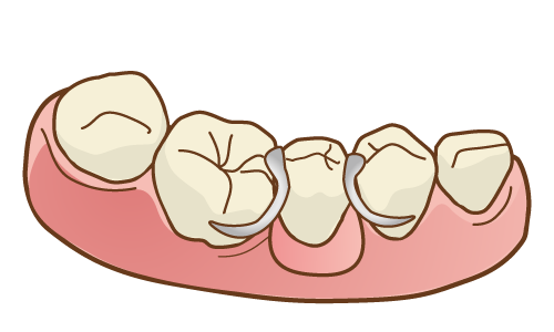 部分入れ歯のイラスト