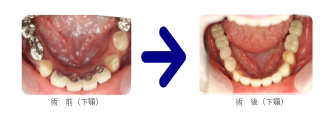 下顎の前後の写真