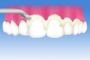 ペースト塗布のイラスト