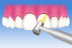 歯と歯の隙間清掃のイラスト