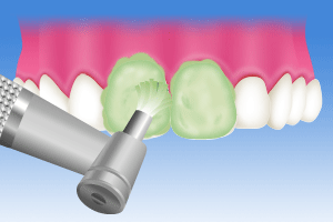 歯の表面のクリーニングのイラスト