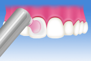 歯の表面のツヤ出しのイラスト