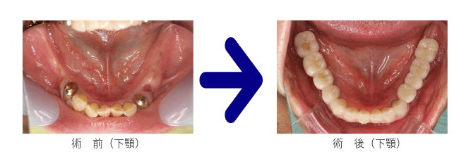 下顎の前後の写真