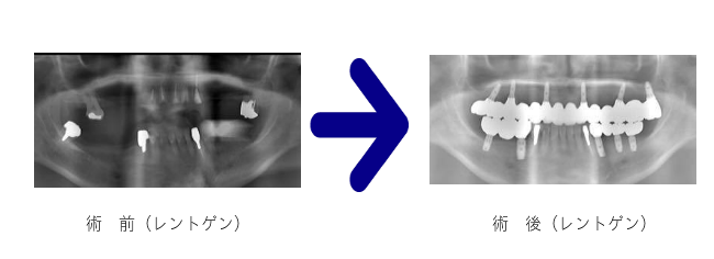 前後のレントゲン写真