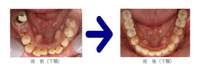 下顎の前後の写真