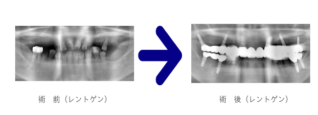 前後のレントゲン写真