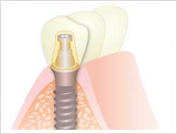 インプラントのイラスト