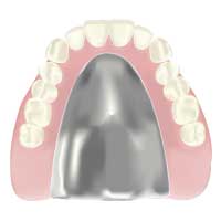 金属床総入れ歯のイラスト