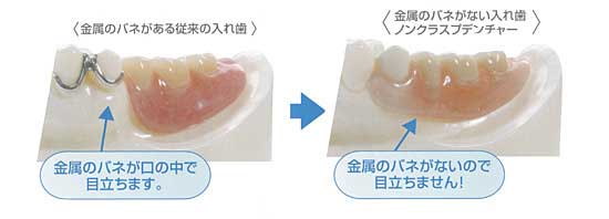 バネがない入れ歯の写真