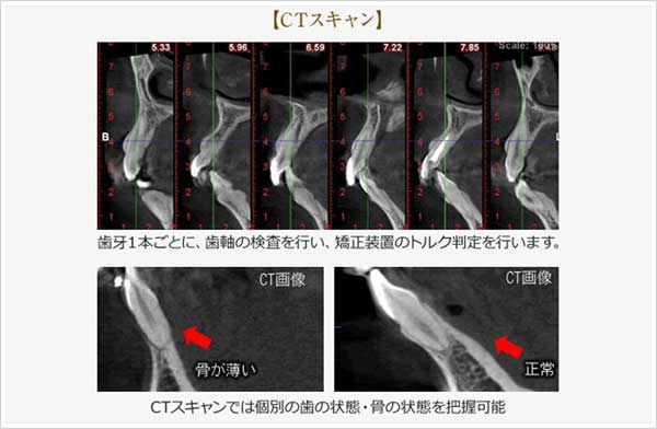 矯正治療にCTを使用している写真