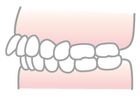 出っ歯のイラスト