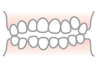 乱ぐい歯のイラスト