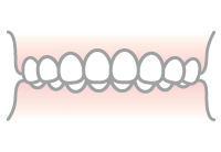 過蓋咬合（かがいこうごう）のイラスト