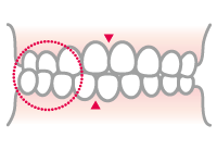 交差咬合のイラスト
