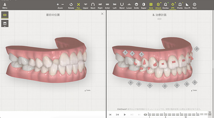 04.データをもとに マウスピース矯正のデザイン