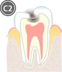 象牙質に達した虫歯のイラスト