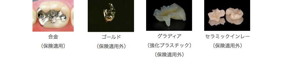 合金の写真 ゴールドの写真 グラディアの写真 セラミックインレーの写真