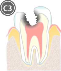 神経に達した虫歯のイラスト