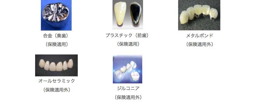 合金の写真 プラスチックの写真 メタルボンドの写真 オールセラミックの写真 ジルコニアの写真
