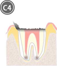 歯質が失われた虫歯のイラスト