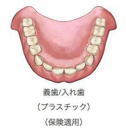 プラスチック入れ歯のイラスト