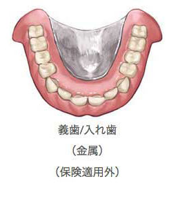 金属入れ歯のイラスト