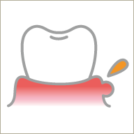 歯ぐきから膿が出ているイラスト