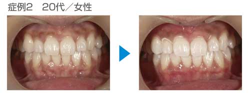 ホワイトニング前後の写真