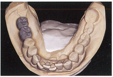 インプラントの被せものを想定した模型