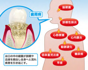 妊娠性歯肉炎