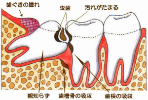 親知らず