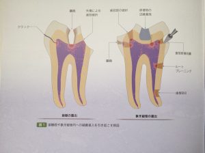 歯髄腔や象牙細管内への細菌侵入を引き起こす原因