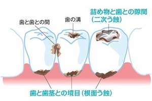 大人の虫歯