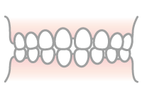 空隙歯列のイラスト