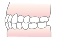 切端咬合のイラスト