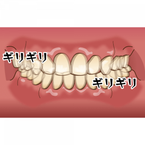 歯ぎしりのイラスト