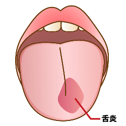 舌 先端 痛い
