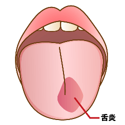 舌炎の原因って どうすればいいの 八王子の歯医者 くろさわ歯科医院
