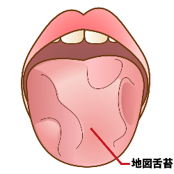 地図状舌って何 原因は 八王子の歯医者 くろさわ歯科医院
