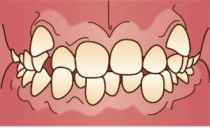 不正咬合のイラスト