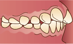 出っ歯（上顎前突）のイラスト