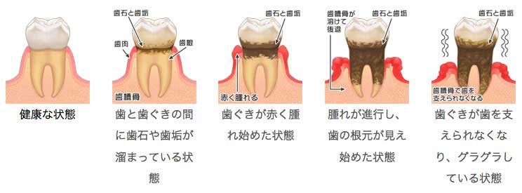 歯周病の症状イラスト