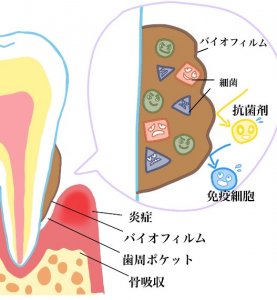 歯周病のイラスト