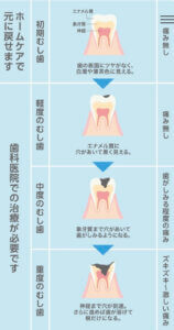 虫歯の進行表