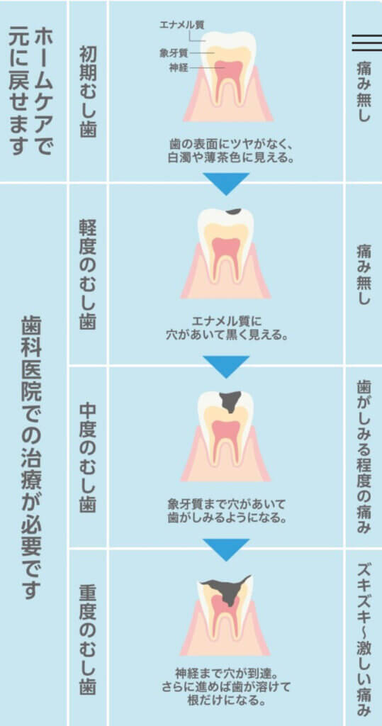 虫歯の進行表