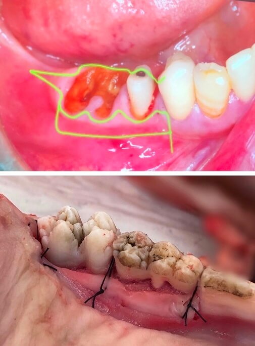 歯周外科治療の口腔内模型